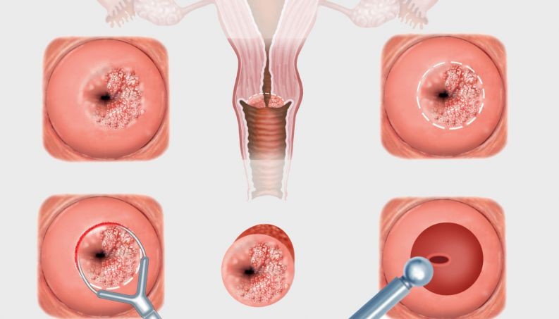 O que é Cervicite O que é Cervicite