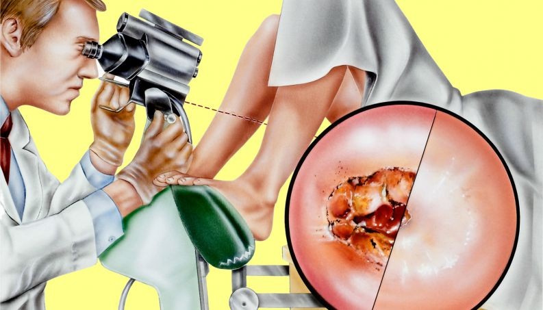 Sintomas de Cervicite Sintomas de Cervicite