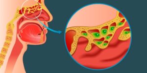 formas naturais de acabar com a sinusite