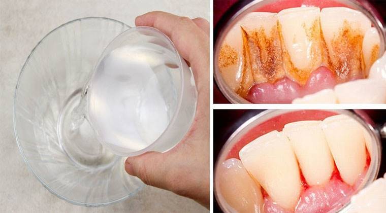 metodo eficaz para eliminar placa bacteriana e clarear os dentes
