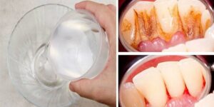 metodo eficaz para eliminar placa bacteriana e clarear os dentes