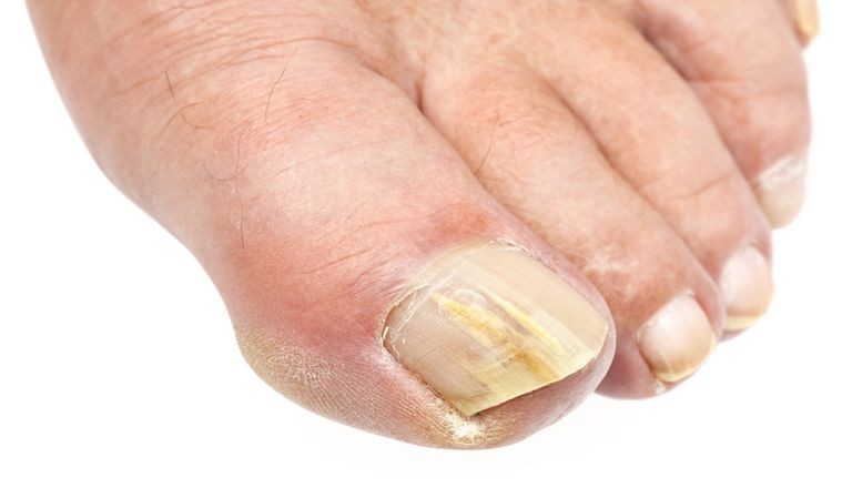 Fungos das Unhas Fungos das Unhas