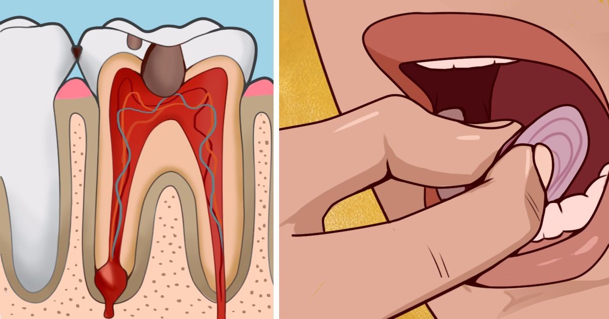 Remédios Caseiros Para Tratar Dor de Dente
