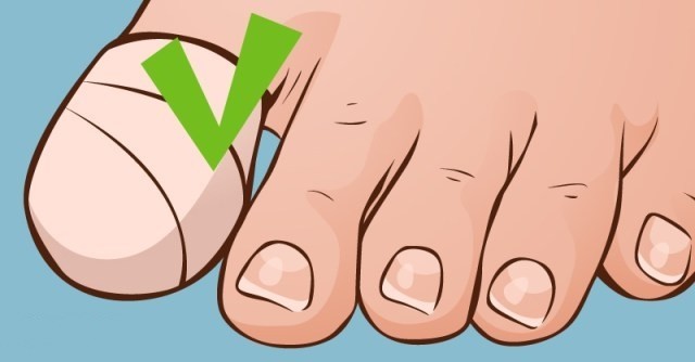 Unhas encravada Unhas encravada