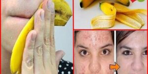 casca de banana para acne