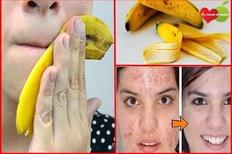 casca de banana para acne