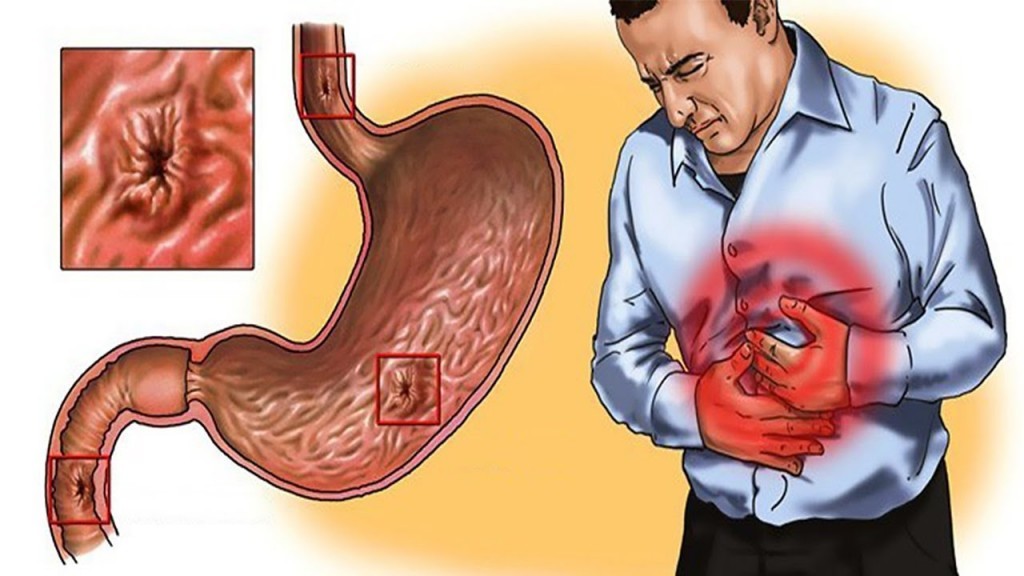 alimentos para tratar gastrite naturalmente