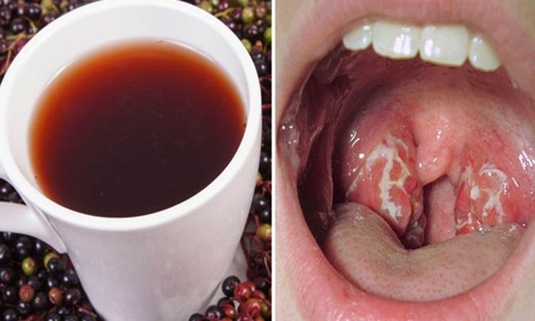 Infecção na Garganta Infecção na Garganta