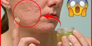 eliminar cicatrizes da acne