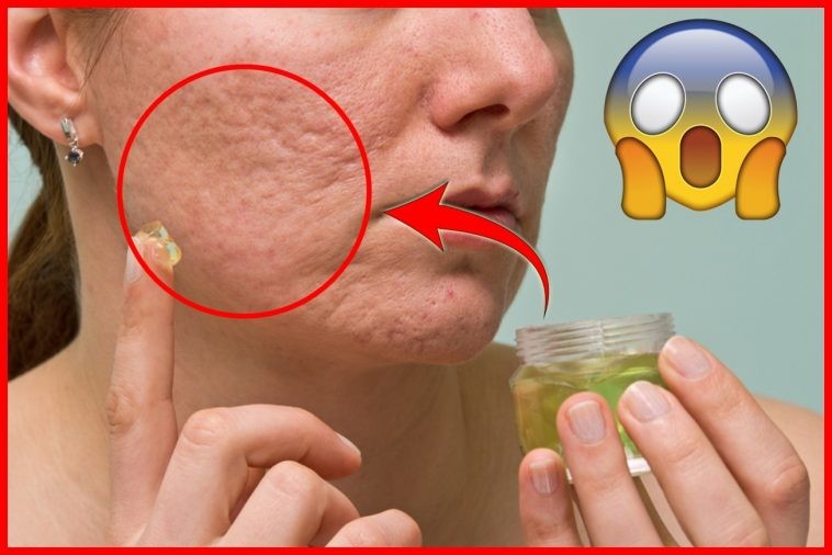 eliminar cicatrizes da acne