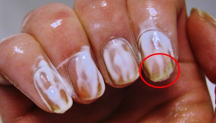 eliminar fungos nas unhas