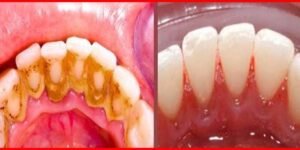 remedio caseiro para eliminar tartaro