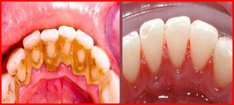remedio caseiro para eliminar tartaro