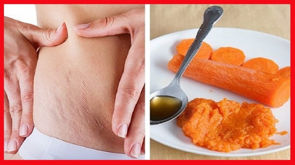 Dicas Para Eliminar as Estrias Dicas Para Eliminar as Estrias