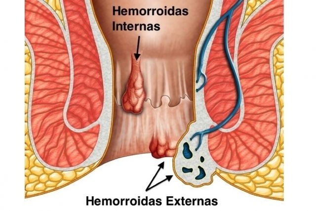 Remédios Caseiros Para Tratar Hemorroidas