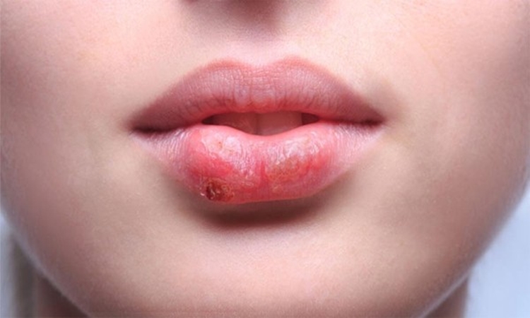 herpes labial