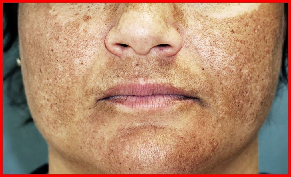 melasma