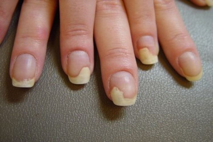 Fungos nas Unhas Fungos nas Unhas