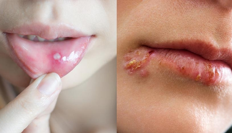 remedios caseiros para herpes labial