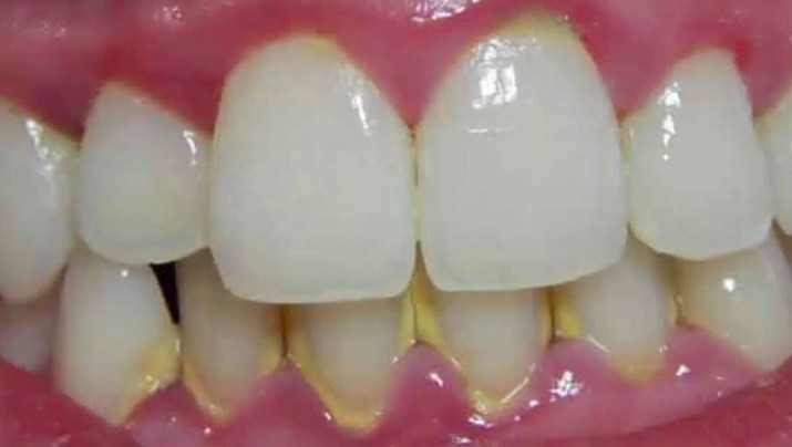 Remover o Tártaro dos Dentes Remover o Tártaro dos Dentes