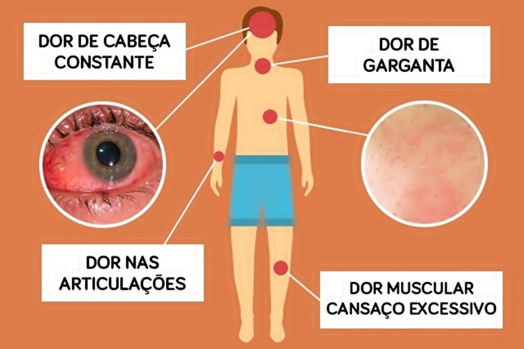 Sintomas de Zika Vírus Sintomas de Zika Vírus