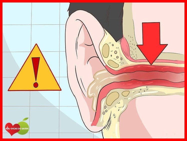 formas de como tirar cera do ouvido