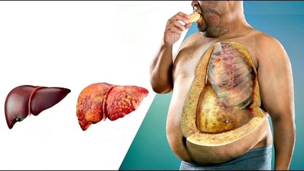 Dieta para tratar o fígado gordo: funciona? cardápio e benefícios