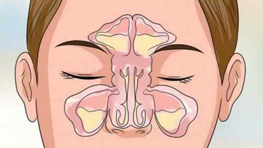 10 Dicas De Como Desentupir O Nariz R pido Dicas De Sa de