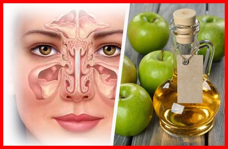 remedios naturais para tratar a sinusite remedios naturais para tratar a sinusite
