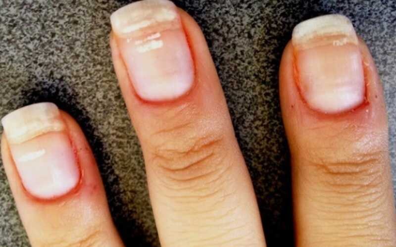 Manchas Brancas nas Unhas - Causas e Tratamento | Dicas de Saúde