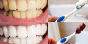Remédios Caseiros Para Clarear os Dentes