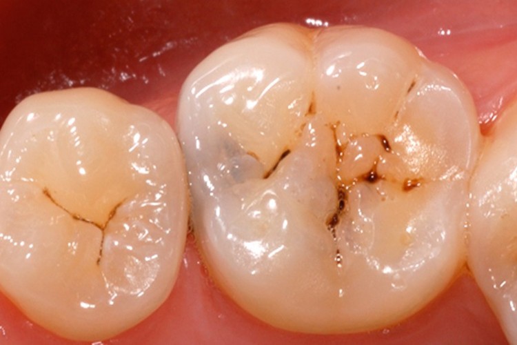 Cárie Dentária