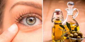 Remédios Naturais Para Aliviar a Inflamação dos Olhos