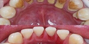 Remover a Placa Bacteriana Tartaro e Manchas dos Dentes