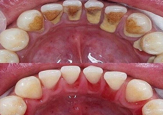 Remover a Placa Bacteriana Tartaro e Manchas dos Dentes