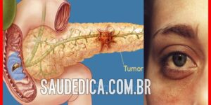 cancer pancreatico