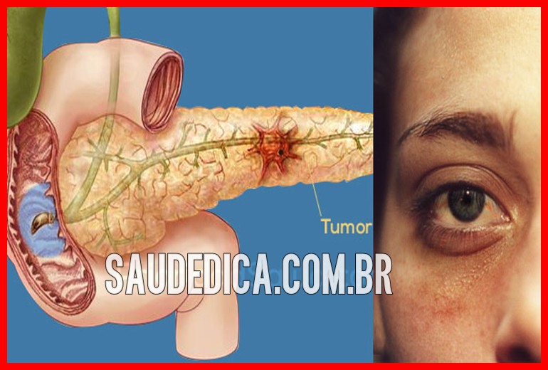 cancer pancreatico