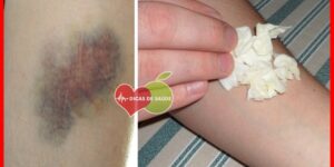 hematoma