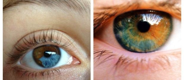 heterocromia