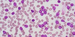 leucemia linfocítica crônica