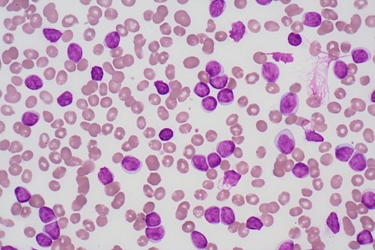 leucemia linfocítica crônica