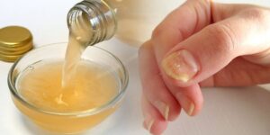 remédios para eliminar os fungos nas unhas