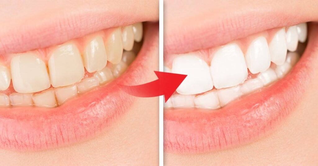 ingredientes naturais para ter dentes brancos