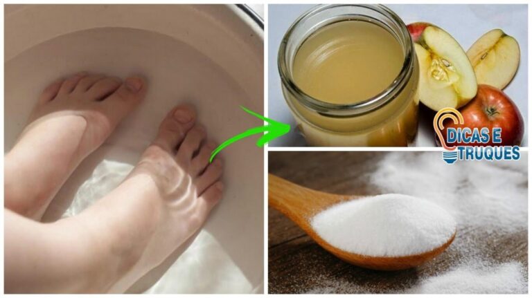 Vinagre de maçã e bicarbonato de sódio para remover fungos nas unhas!