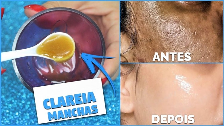 batata e limão para eliminar rugas e cicatrizes de acne