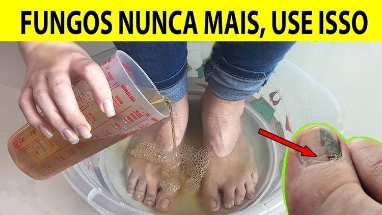 receita caseira para eliminar fungos das unhas