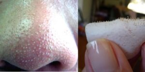 eliminar os cravos no nariz