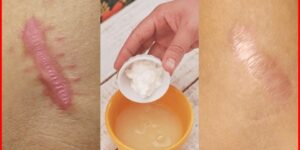remédios caseiros para eliminar cicatrizes e nutrir a pele