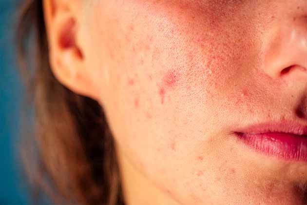 acne excessiva é sinal que você precisa de reposição hormonal