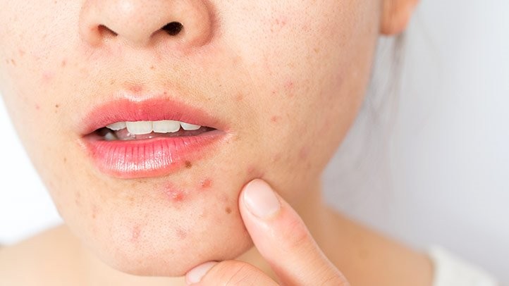 beneficios do oleo essencial de lavanda para prevenir acne